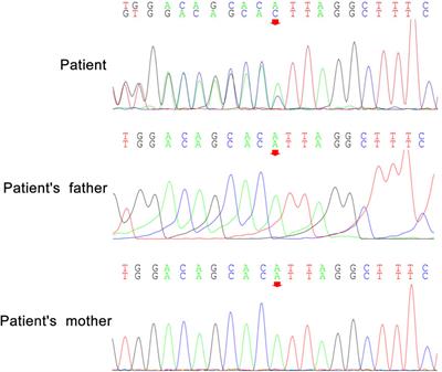 Case report: Novel NUS1 variant in a Chinese patient with tremors and intellectual disability